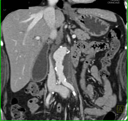 Retroperitoneal Fibrosis With Obstructed Common Bile Duct (CBD) and Left Renal Pelvis- See Full Sequence - CTisus CT Scan