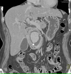 Retroperitoneal Fibrosis With Obstructed Common Bile Duct (CBD) and Left Renal Pelvis- See Full Sequence - CTisus CT Scan