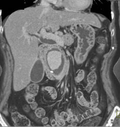 Retroperitoneal Fibrosis With Obstructed Common Bile Duct (CBD) and Left Renal Pelvis- See Full Sequence - CTisus CT Scan