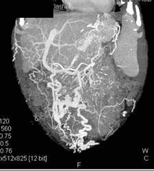 Retroperitoneal Fibrosis With Obstructed Common Bile Duct (CBD) and Left Renal Pelvis- See Full Sequence - CTisus CT Scan