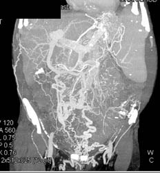 Retroperitoneal Fibrosis With Obstructed Common Bile Duct (CBD) and Left Renal Pelvis- See Full Sequence - CTisus CT Scan