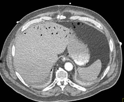 Emphysematous Gastritis and Portal Venous Air. Patient Also Has Small Bowel Pneumatosis - CTisus CT Scan