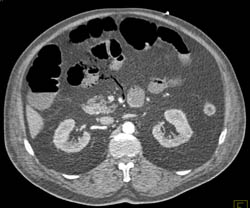 Emphysematous Gastritis and Portal Venous Air. Patient Also Has Small Bowel Pneumatosis - CTisus CT Scan