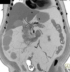 Emphysematous Gastritis and Portal Venous Air. Patient Also Has Small Bowel Pneumatosis - CTisus CT Scan