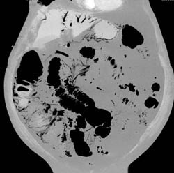 Emphysematous Gastritis and Portal Venous Air. Patient Also Has Small Bowel Pneumatosis - CTisus CT Scan