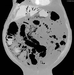 Emphysematous Gastritis and Portal Venous Air. Patient Also Has Small Bowel Pneumatosis - CTisus CT Scan