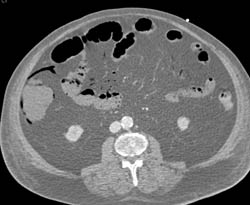 Emphysematous Gastritis and Portal Venous Air. Patient Also Has Small Bowel Pneumatosis - CTisus CT Scan