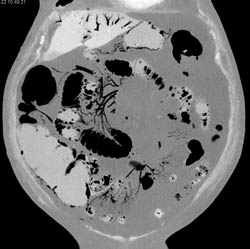 Emphysematous Gastritis and Portal Venous Air. Patient Also Has Small Bowel Pneumatosis - CTisus CT Scan