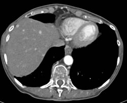 Recurrent Renal Cell Carcinoma Metastatic to Liver and Nodes - CTisus CT Scan