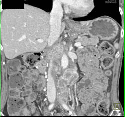 Recurrent Renal Cell Carcinoma Metastatic to Liver and Nodes - CTisus CT Scan