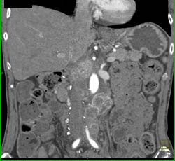 Recurrent Renal Cell Carcinoma Metastatic to Liver and Nodes - CTisus CT Scan