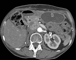 Recurrent Renal Cell Carcinoma Metastatic to Liver and Nodes - CTisus CT Scan