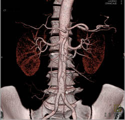 Hepatic Artery Arises Directly Off the Aorta - CTisus CT Scan