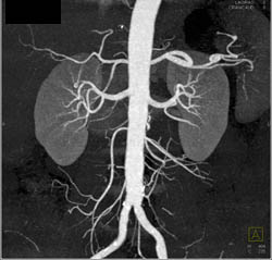 Hepatic Artery Arises Directly Off the Aorta - CTisus CT Scan