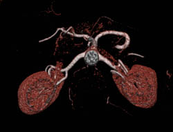 Hepatic Artery Arises Directly Off the Aorta - CTisus CT Scan