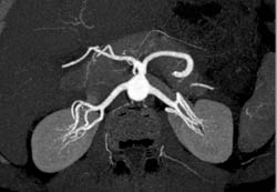 Hepatic Artery Arises Directly Off the Aorta - CTisus CT Scan