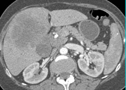 Gallbladder Cancer Invades the Liver - CTisus CT Scan