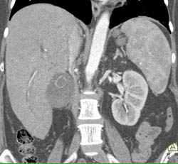 Gallbladder Cancer Invades the Liver - CTisus CT Scan