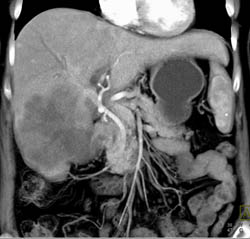 Gallbladder Cancer Invades the Liver - CTisus CT Scan