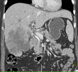 Gallbladder Cancer Invades the Liver - CTisus CT Scan