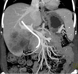 Gallbladder Cancer Invades the Liver - CTisus CT Scan