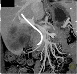 Gallbladder Cancer Invades the Liver - CTisus CT Scan