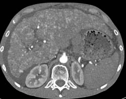 Cirrhosis With Large Varices and Portal Hypertension- See Full Sequence - CTisus CT Scan