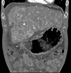 Cirrhosis With Large Varices and Portal Hypertension- See Full Sequence - CTisus CT Scan