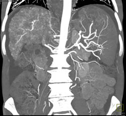 Cirrhosis With Large Varices and Portal Hypertension- See Full Sequence - CTisus CT Scan