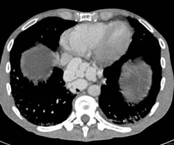 Cirrhosis With Large Varices and Portal Hypertension- See Full Sequence - CTisus CT Scan