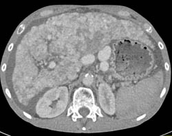 Cirrhosis With Large Varices and Portal Hypertension- See Full Sequence - CTisus CT Scan