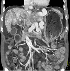 Cirrhosis With Large Varices and Portal Hypertension- See Full Sequence - CTisus CT Scan