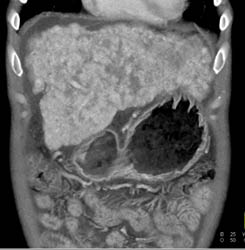 Cirrhosis With Large Varices and Portal Hypertension- See Full Sequence - CTisus CT Scan