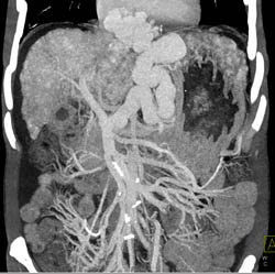 Cirrhosis With Large Varices and Portal Hypertension- See Full Sequence - CTisus CT Scan