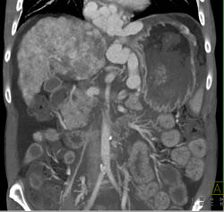 Cirrhosis With Large Varices and Portal Hypertension- See Full Sequence - CTisus CT Scan