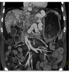 Cirrhosis With Large Varices and Portal Hypertension- See Full Sequence - CTisus CT Scan