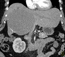 Giant Cavernous Hemangioma - CTisus CT Scan