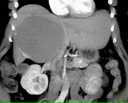 Giant Cavernous Hemangioma - CTisus CT Scan