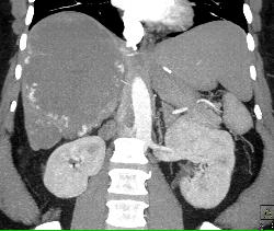 Giant Cavernous Hemangioma - CTisus CT Scan