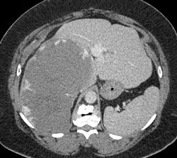 Giant Cavernous Hemangioma - CTisus CT Scan