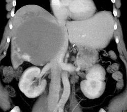 Giant Cavernous Hemangioma - CTisus CT Scan