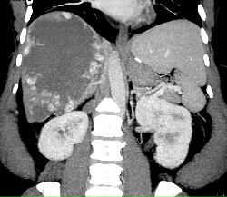 Giant Cavernous Hemangioma - CTisus CT Scan