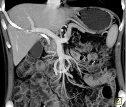 Subtle Common Bile Duct (CBD) Tumor Invades the Portal Vein - CTisus CT Scan