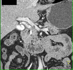 Subtle Common Bile Duct (CBD) Tumor Invades the Portal Vein - CTisus CT Scan