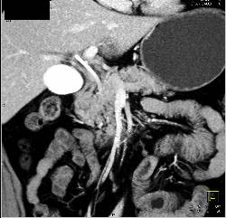 Subtle Common Bile Duct (CBD) Tumor Invades the Portal Vein - CTisus CT Scan