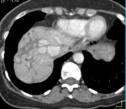 Cirrhosis - CTisus CT Scan