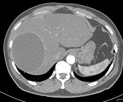 Hepatic Cyst - CTisus CT Scan