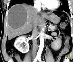 Hepatic Cyst - CTisus CT Scan