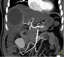 Hepatic Cyst - CTisus CT Scan