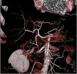 Hepatic Cyst - CTisus CT Scan